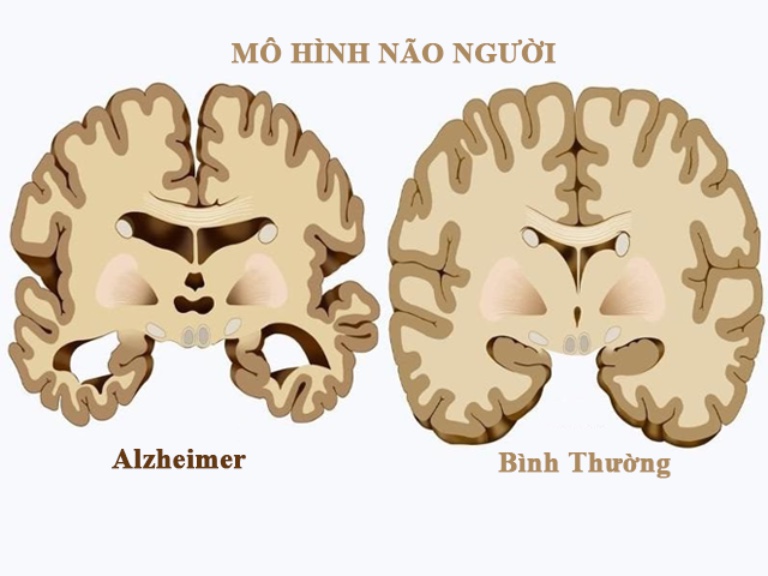 Bệnh Alzheimer